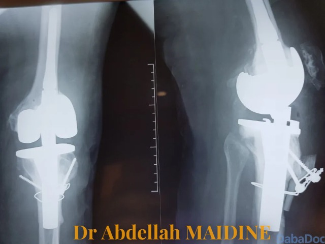 Est-on obligé de se faire opérer en cas de lésion du ligament croisé ? — photo 3 — Dr Abdellah MAIDINE