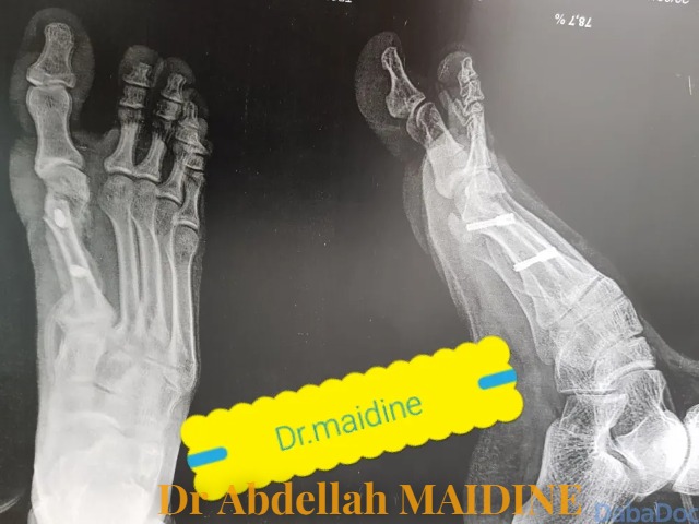 Est-on obligé de se faire opérer en cas de lésion du ligament croisé ? — photo 4 — Dr Abdellah MAIDINE