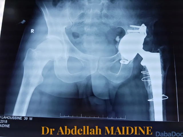 Est-on obligé de se faire opérer en cas de lésion du ligament croisé ? — photo 1 — Dr Abdellah MAIDINE
