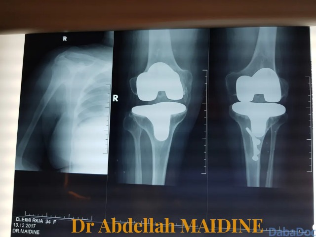 Est-on obligé de se faire opérer en cas de lésion du ligament croisé ? — photo 2 — Dr Abdellah MAIDINE