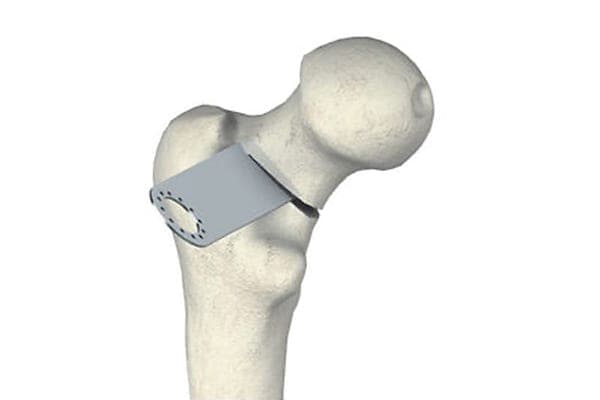 operation de la hanche et col du femur dr Abdellah Maidine chirurgien specialiste orthopediste et traumatologue chirurgie orthopedique Agadir operation de la hanche et col du femur dr Abdellah Maidine chirurgien specialiste orthopediste et traumatologue chirurgie orthopedique Agadir
