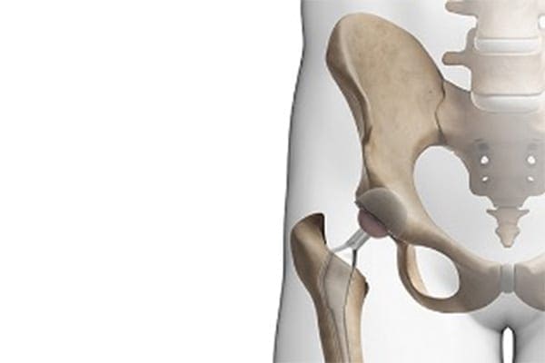 type de prothese de hanche dr Abdellah Maidine chirurgien specialiste orthopediste et traumatologue chirurgie orthopedique Agadir type de prothese de hanche dr Abdellah Maidine chirurgien specialiste orthopediste et traumatologue chirurgie orthopedique Agadir