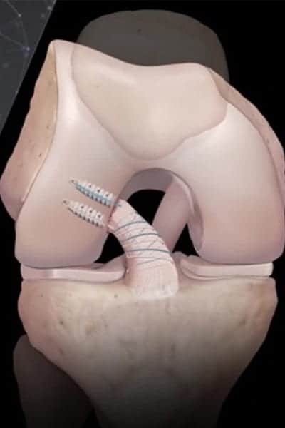 reconstruction ligament croise anterieur genou docteur Abdellah Maidine chirurgien specialiste orthopediste et traumatologue chirurgie orthopedique Agadir reconstruction ligament croise anterieur genou docteur Abdellah Maidine chirurgien specialiste orthopediste et traumatologue chirurgie orthopedique Agadir