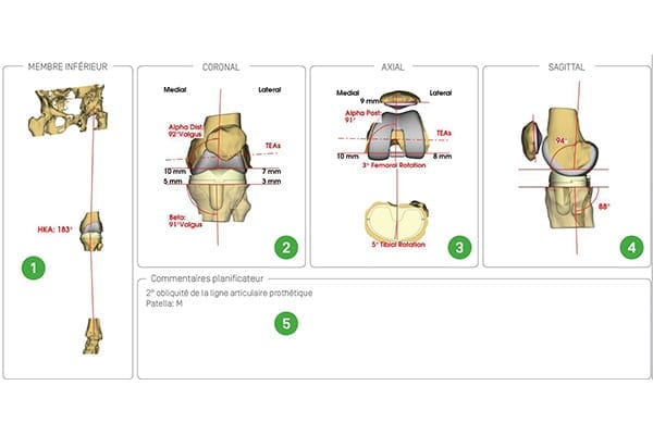prothese de genou sur mesure dr Abdellah Maidine chirurgien specialiste orthopediste et traumatologue chirurgie orthopedique Agadir