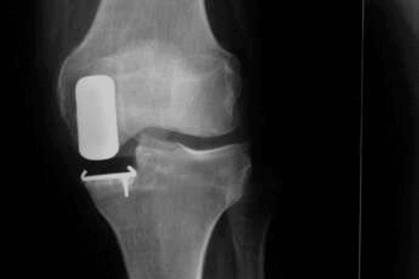 prothese partielle unicompartimentale genou docteur Abdellah Maidine chirurgien hanche genou orthopediste Agadir