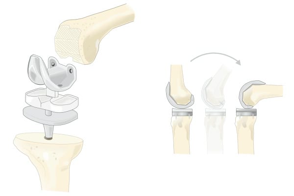 prothese totale de genou dr Abdellah Maidine chirurgien specialiste orthopediste et traumatologue chirurgie orthopedique Agadir