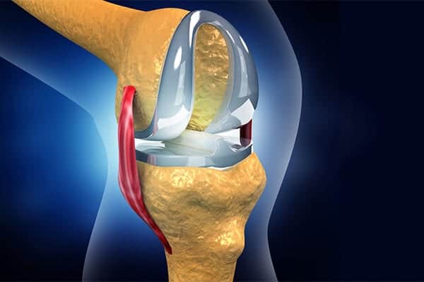 prothese totale genou dr Abdellah Maidine chirurgien specialiste orthopediste et traumatologue chirurgie orthopedique Agadir