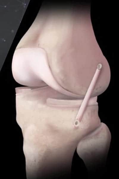 reconstruction ligament croise anterieur genou docteur Abdellah Maidine chirurgien specialiste orthopediste et traumatologue chirurgie orthopedique Agadir reconstruction ligament croise anterieur genou docteur Abdellah Maidine chirurgien specialiste orthopediste et traumatologue chirurgie orthopedique Agadir