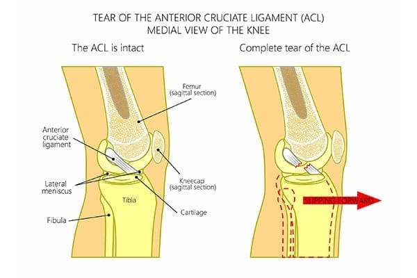 rupture lca ligament croise anterieur dr Abdellah Maidine chirurgien specialiste orthopediste et traumatologue chirurgie orthopedique Agadir rupture lca ligament croise anterieur dr Abdellah Maidine chirurgien specialiste orthopediste et traumatologue chirurgie orthopedique Agadir