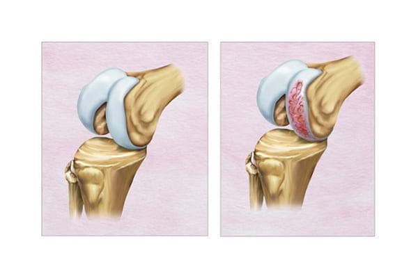 usure du cartilage genou dr Abdellah Maidine chirurgien specialiste orthopediste et traumatologue chirurgie orthopedique Agadir