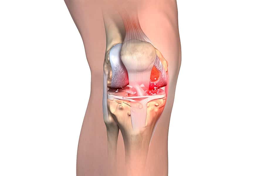 arthrose du genou docteur Abdellah Maidine chirurgien specialiste orthopediste et traumatologue chirurgie orthopedique Agadir