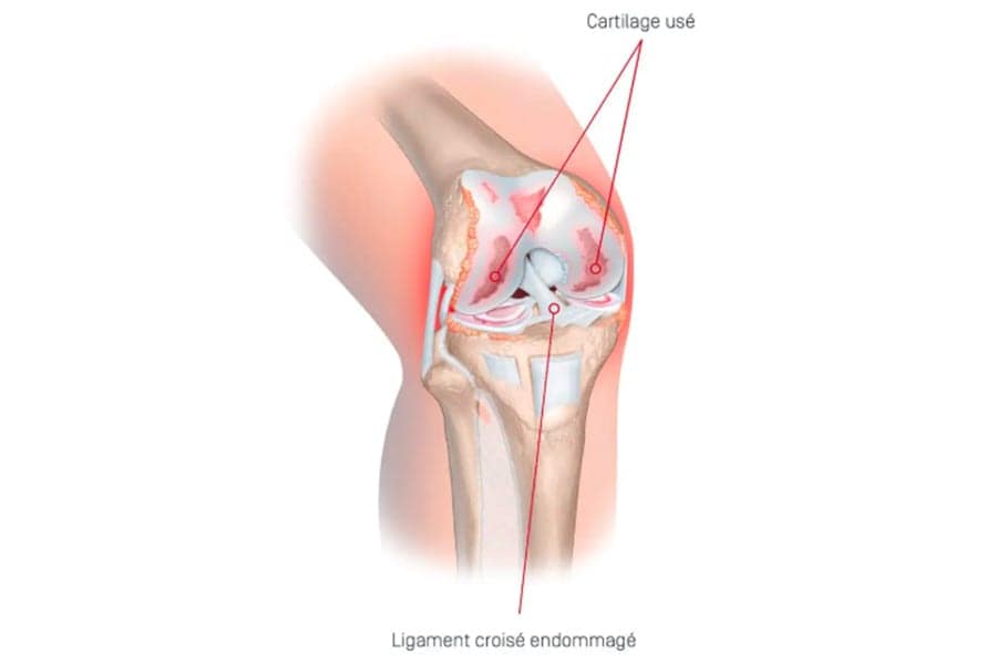 cartilage-abime-genoux-dr-thomas-xavier-haen-chirurgien-specialiste-orthopediste-et-traumatologue-chirurgie-orthopedique-paris.jpg
