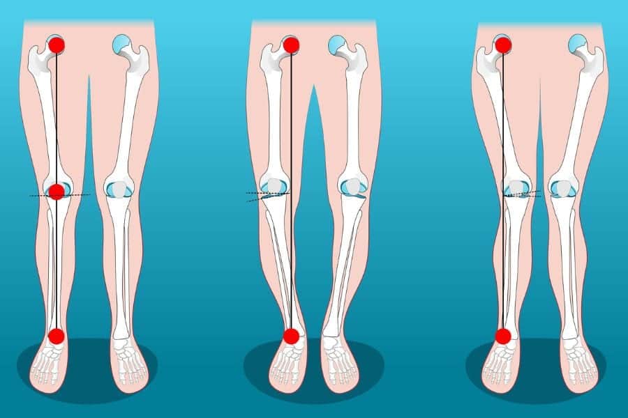 sport apres prothese genou docteur Abdellah Maidine chirurgien specialiste orthopediste et traumatologue chirurgie orthopedique Agadir