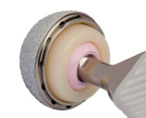 prothese de hanche a double mobilite luxation de prothese de hanche docteur Abdellah Maidine chirurgien specialiste orthopediste traumatologue hanche genou chirurgie orthopedique Agadir