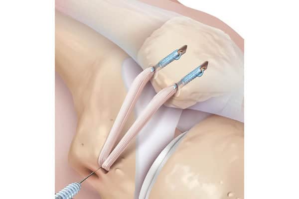 luxation rotule dr Abdellah Maidine chirurgien specialiste orthopediste traumatologue hanche genou chirurgie orthopedique Agadir luxation rotule dr Abdellah Maidine chirurgien specialiste orthopediste traumatologue hanche genou chirurgie orthopedique Agadir